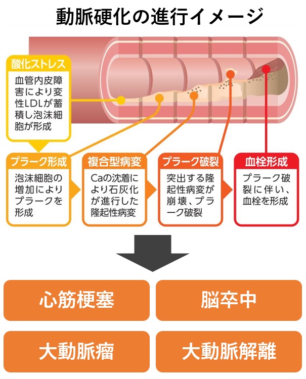 と は 硬化 動脈 動脈硬化の怖さを知ろう｜動脈硬化はなぜ怖い？